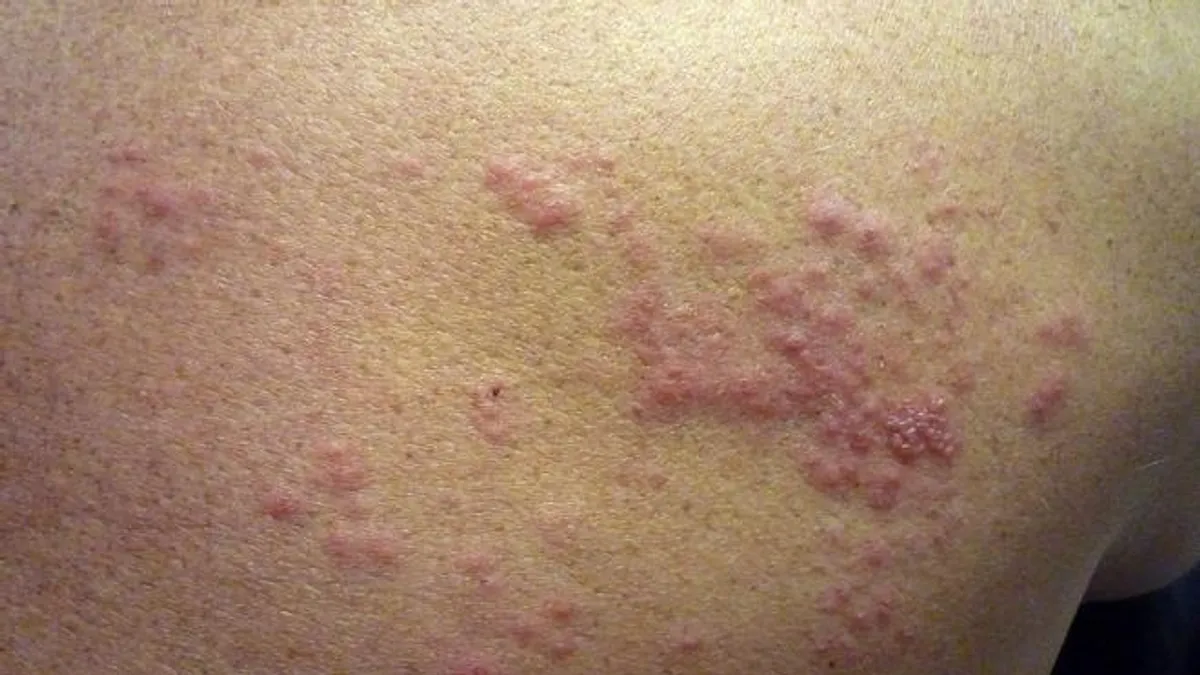 Herpes Zóster: La Enfermedad Que Afectará a un 30% de la Población